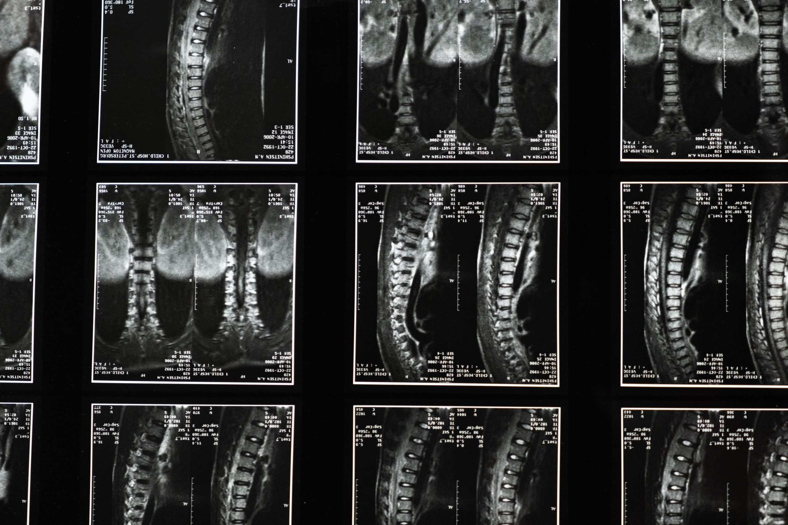 Correction de la courbure cervicale inversée