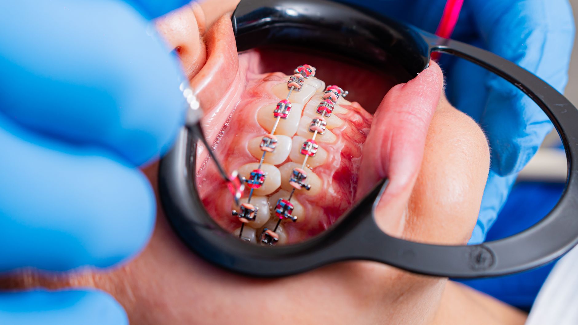 Dentiste examinant un appareil dentaire de près